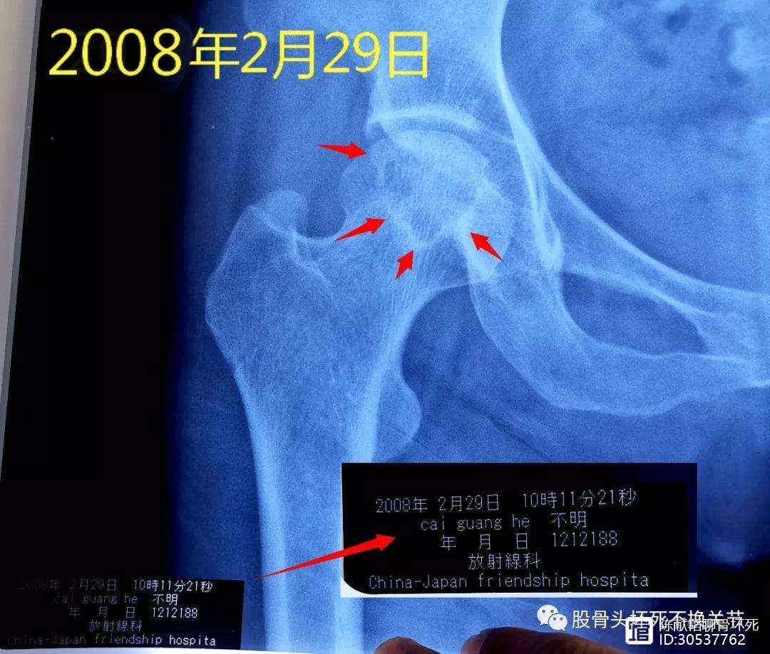 长治人工骨头医保报销多少(人工骨头医保报销多少比例)