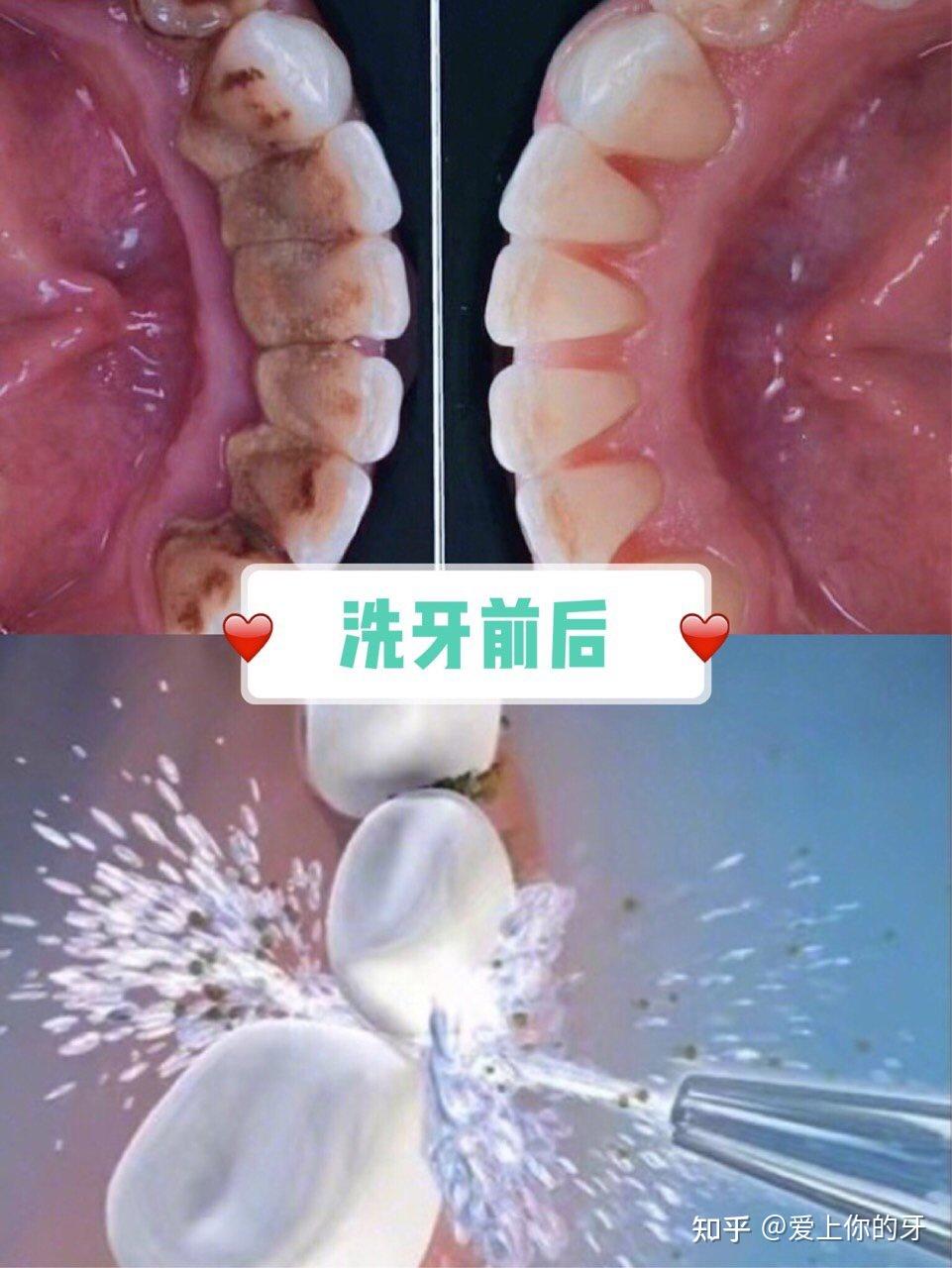 长治洗牙可以用医保吗(洗牙可以用医保吗,报销比例多少)